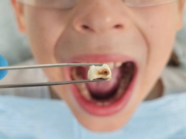 Best Emergency Dental Filling Replacement  in Moscow, PA